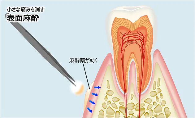 表面麻酔