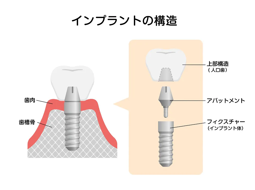 見た目が美しく、よく噛めるインプラント治療とは？